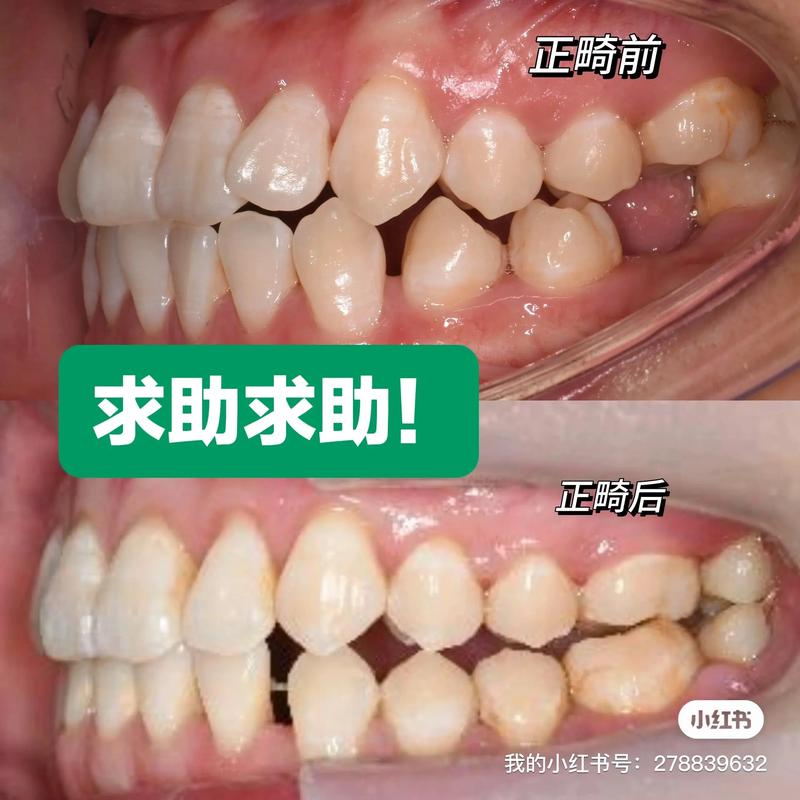 正畸咬合平面倾斜-图3