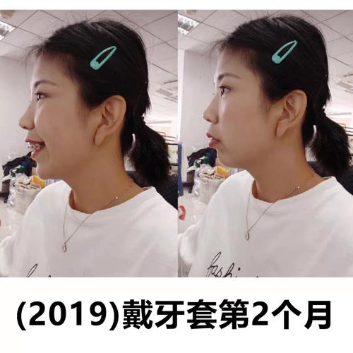 杭州龅牙快速正畸效果如何?矫正周期多久?-图3 杭州龅牙快速正畸效果如何?矫正周期多久?-图3