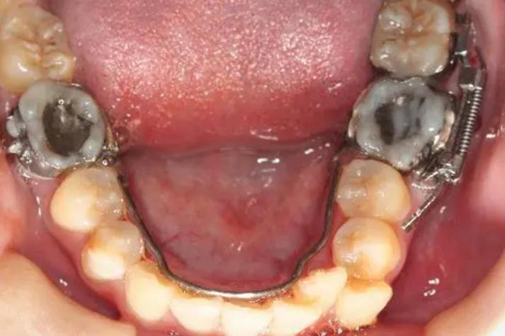 正畸 推磨牙向前-图1