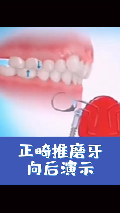 正畸 推磨牙向前-图2