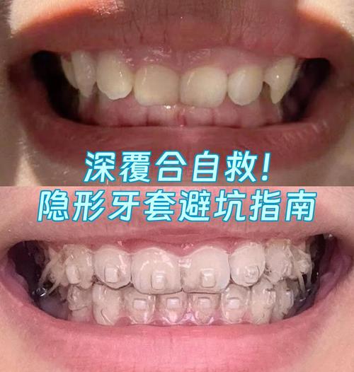 隐形正畸真的没用?这些原因让矫正白做了!-图2 隐形正畸真的没用?这些原因让矫正白做了!-图2