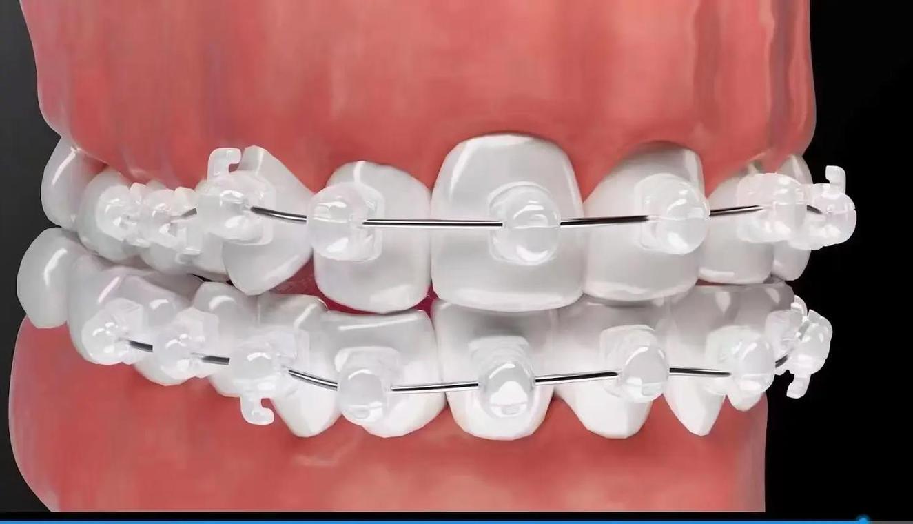 正畸托槽粘贴视频如何学？粘贴步骤技巧全掌握-图1