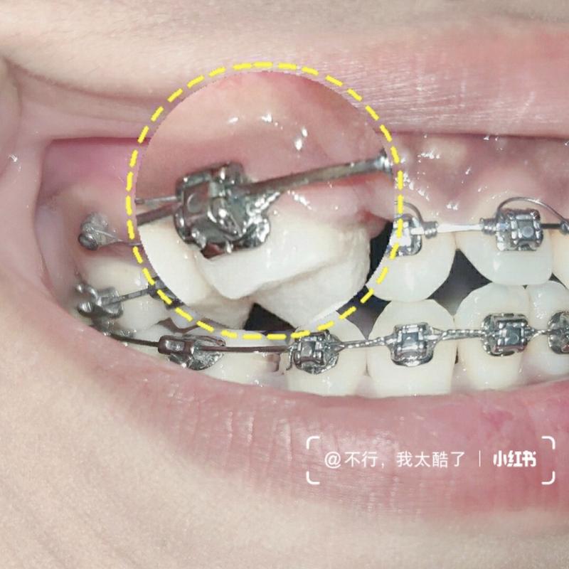 正畸托槽粘贴视频如何学？粘贴步骤技巧全掌握-图2