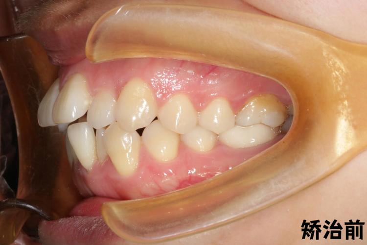 季红正畸对不同口腔错颌畸形效果如何?-图2 季红正畸对不同口腔错颌畸形效果如何?-图2