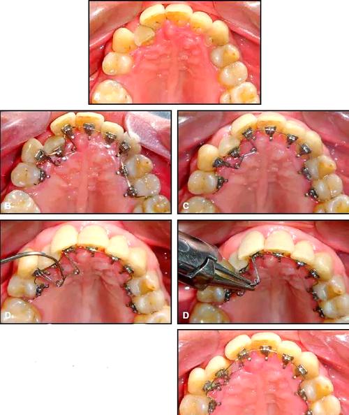 日本LH正畸技术是什么？效果和优势如何？-图3