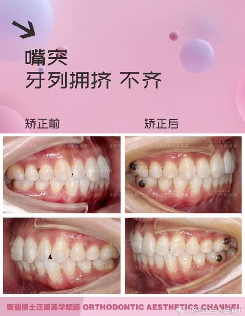 错合会导致磨牙？正畸如何应对？-图2