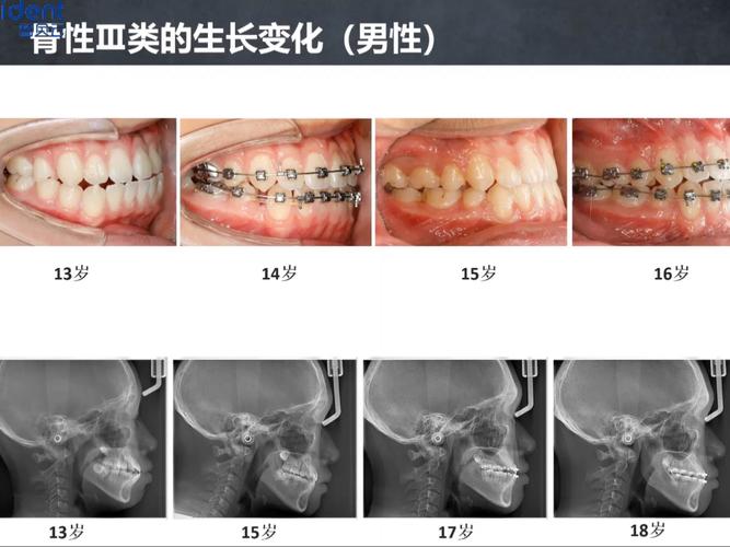 成人正畸患者比例有多少？增长趋势及原因何在？-图1