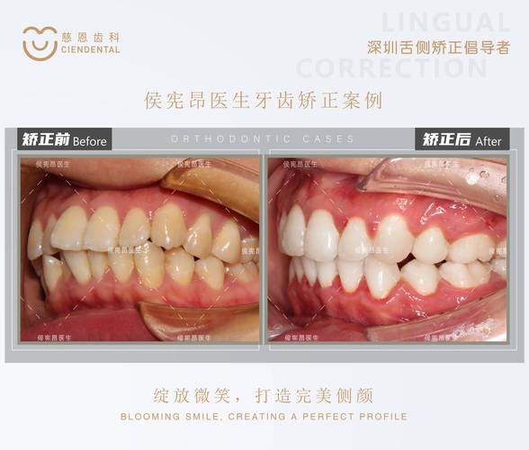 口腔正畸照相技巧-图3
