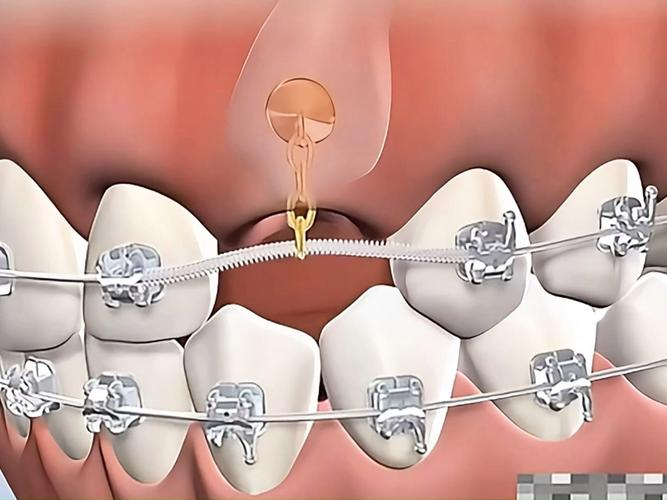 门牙缺失牵引正畸-图1