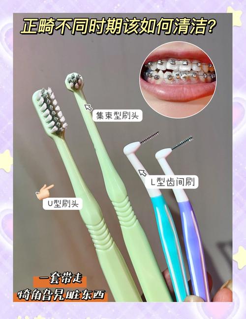 正畸期间怎么清洁-图2 正畸期间怎么清洁-图2