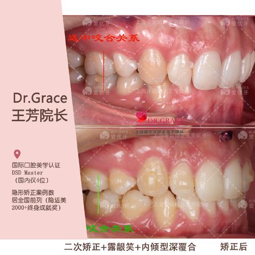 上海正畸不用排队-图3