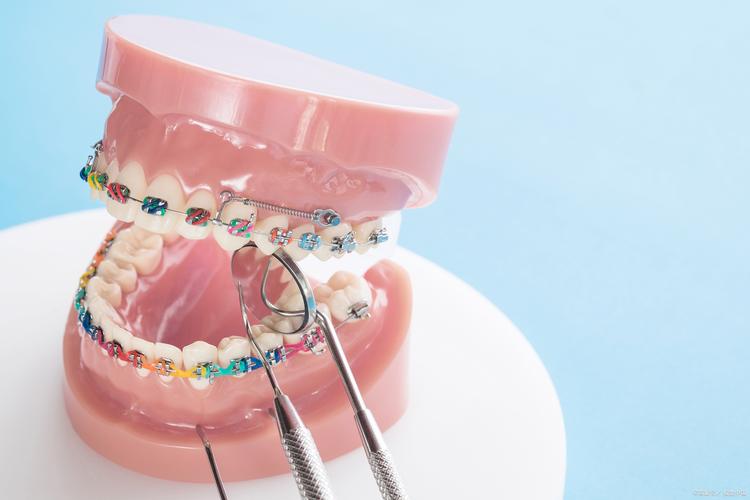 正畸戴皮筋效果真的好吗？一般戴多久才能看到改善？-图3