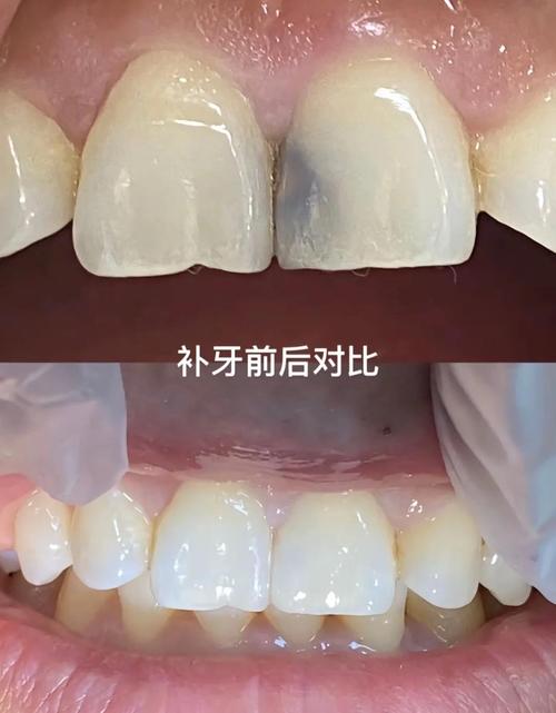 正畸期间可否补牙-图1