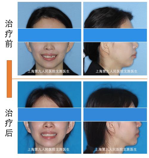 正畸病例上HNT，有何特殊考量与意义？-图3