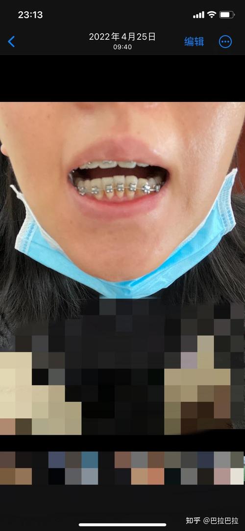 rw正畸失败案例-图2