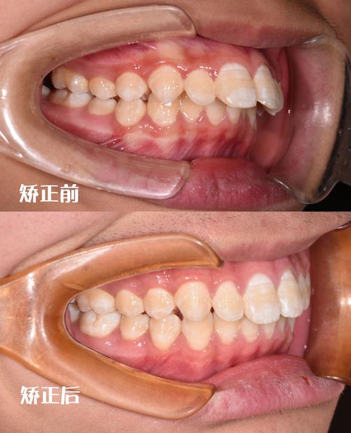 牙齿正畸手术案例-图2