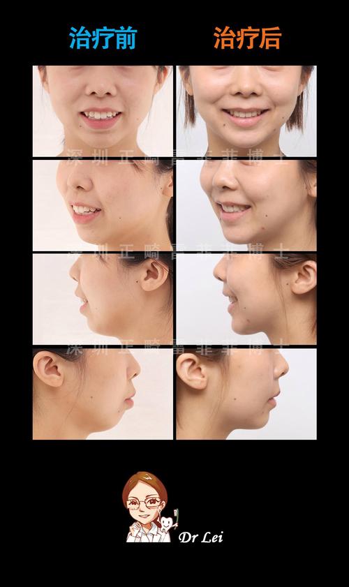 牙齿正畸手术案例-图1