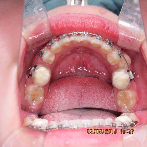 正畸牵引尖牙博客-图1