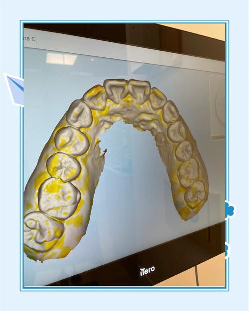 正畸模型测量视频-图1