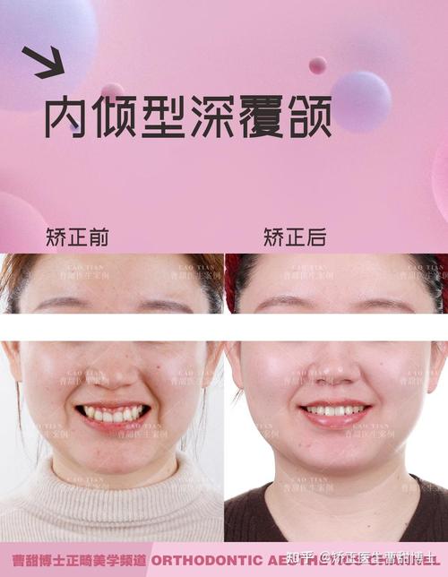 成人牙齿正畸对比-图2