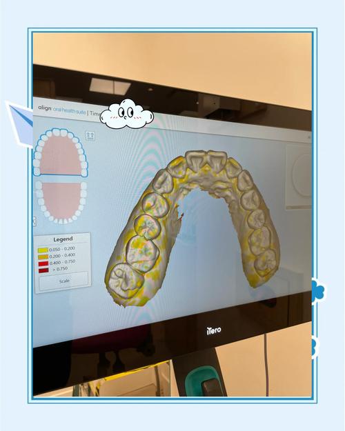 牙科正畸模型展示-图2 牙科正畸模型展示-图2