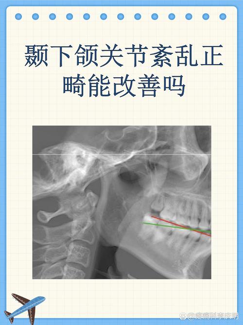 颞下颌 RW正畸-图1