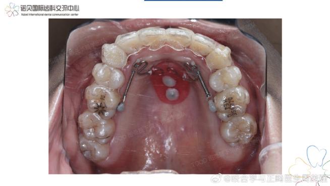 颞下颌 RW正畸-图2