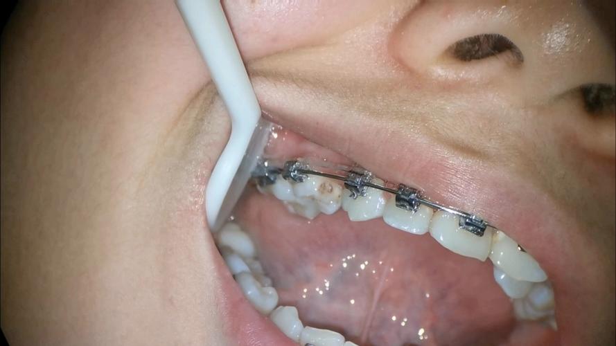 正畸期间蛀牙掉了，矫正会受影响吗？该怎么处理？-图1