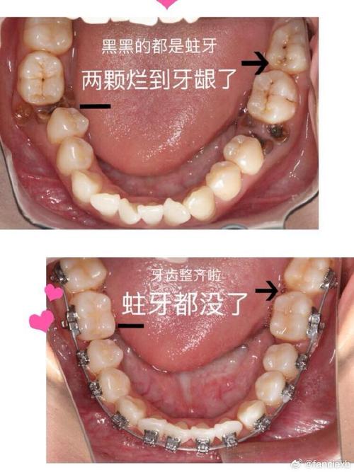 正畸期间蛀牙掉了，矫正会受影响吗？该怎么处理？-图2