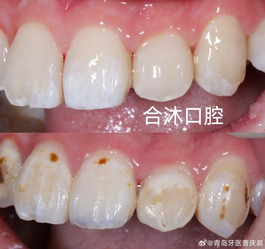 正畸期间蛀牙掉了，矫正会受影响吗？该怎么处理？-图3