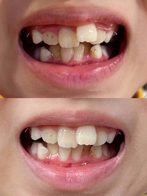 儿童口腔正畸图片-图1