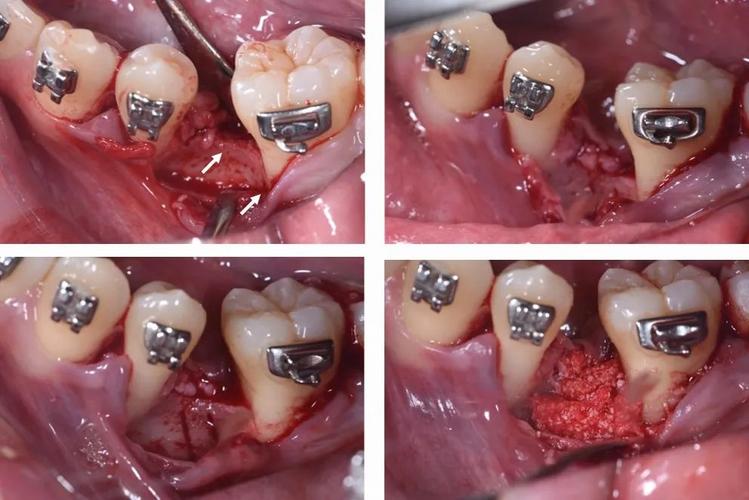牙齿正畸关闭间隙-图1 牙齿正畸关闭间隙-图1