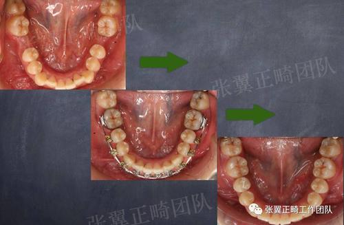 牙齿正畸关闭间隙-图2 牙齿正畸关闭间隙-图2