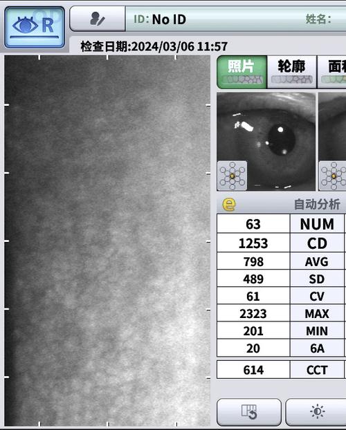 隐形正畸病例报告，疗效与美观如何兼顾？-图1