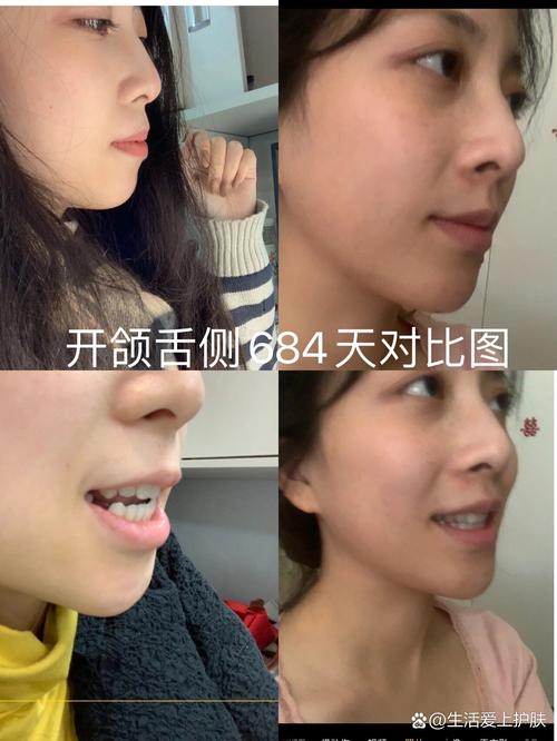 开颌 正畸 案例-图1