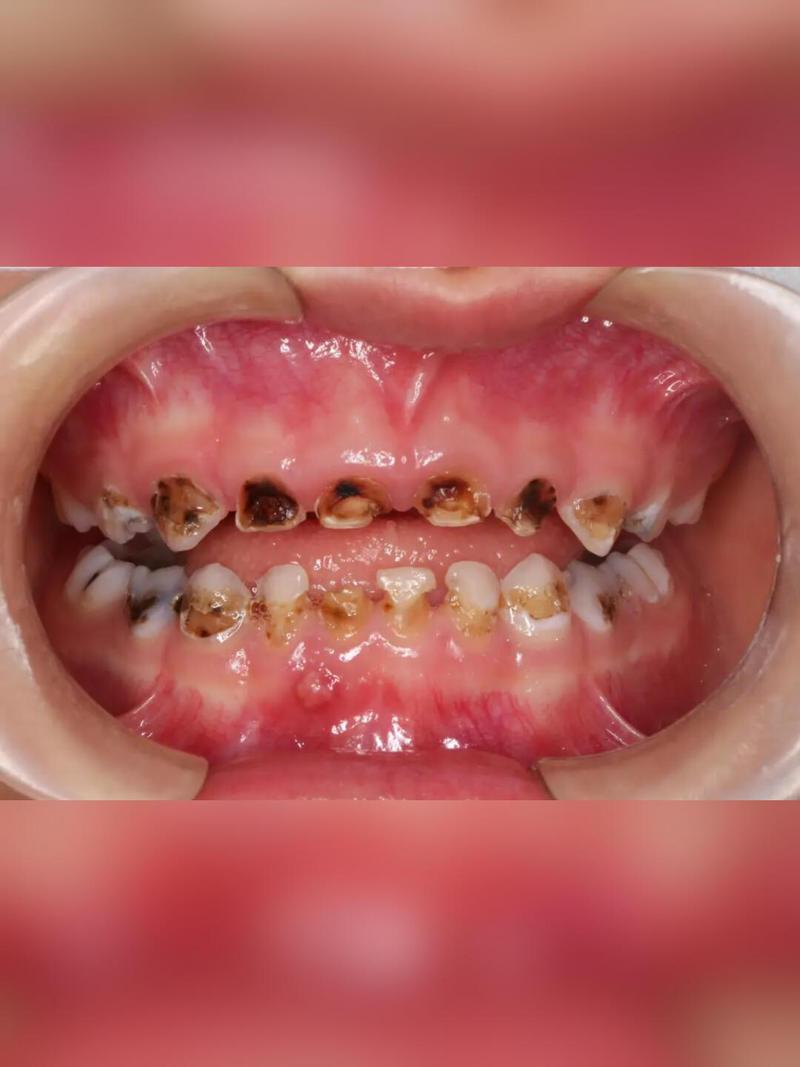 牙齿正畸出现虫牙-图1