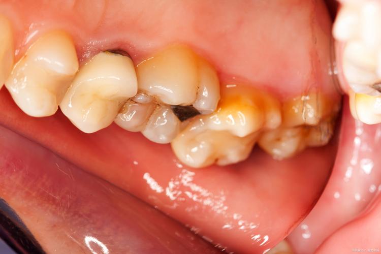 牙齿正畸出现虫牙-图3