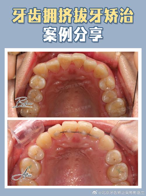 正畸牙齿牙龈脱离-图2