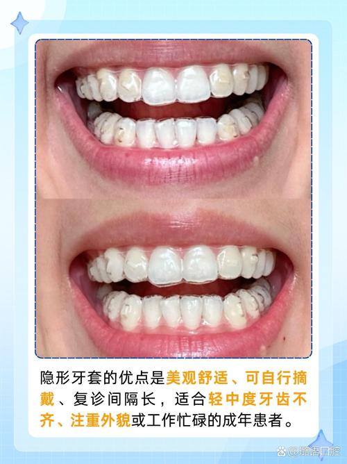 隐形正畸矫正龅牙效果如何？靠谱吗？-图2