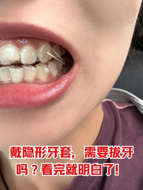 隐形正畸矫正龅牙效果如何？靠谱吗？-图3