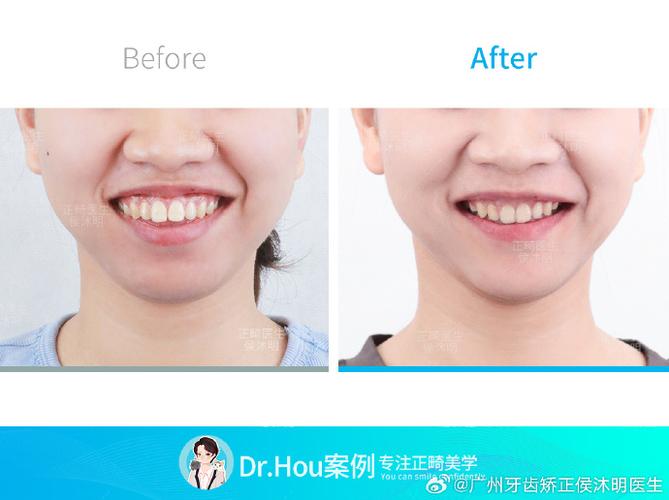 广州牙齿快速正畸-图1