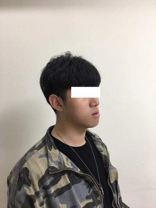 齐齐哈尔偏颌正畸-图2