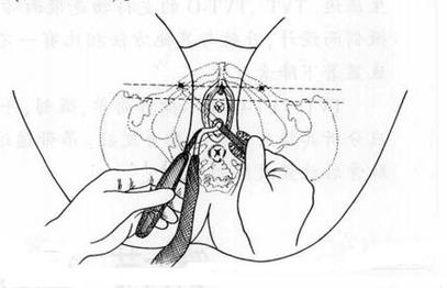 正畸悬吊结扎图解,关键步骤如何操作?-图1 正畸悬吊结扎图解,关键步骤如何操作?-图1