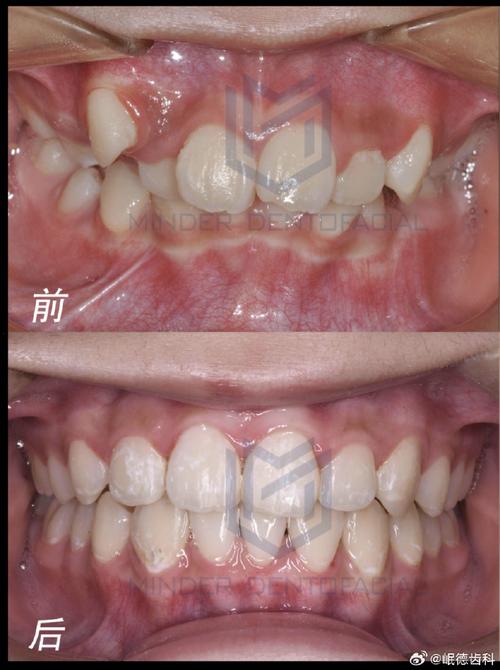 华西正畸前后对比-图2 华西正畸前后对比-图2