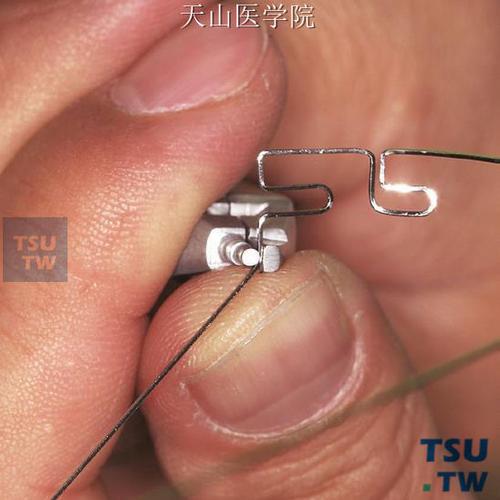 meaw弓 正畸-图2 meaw弓 正畸-图2