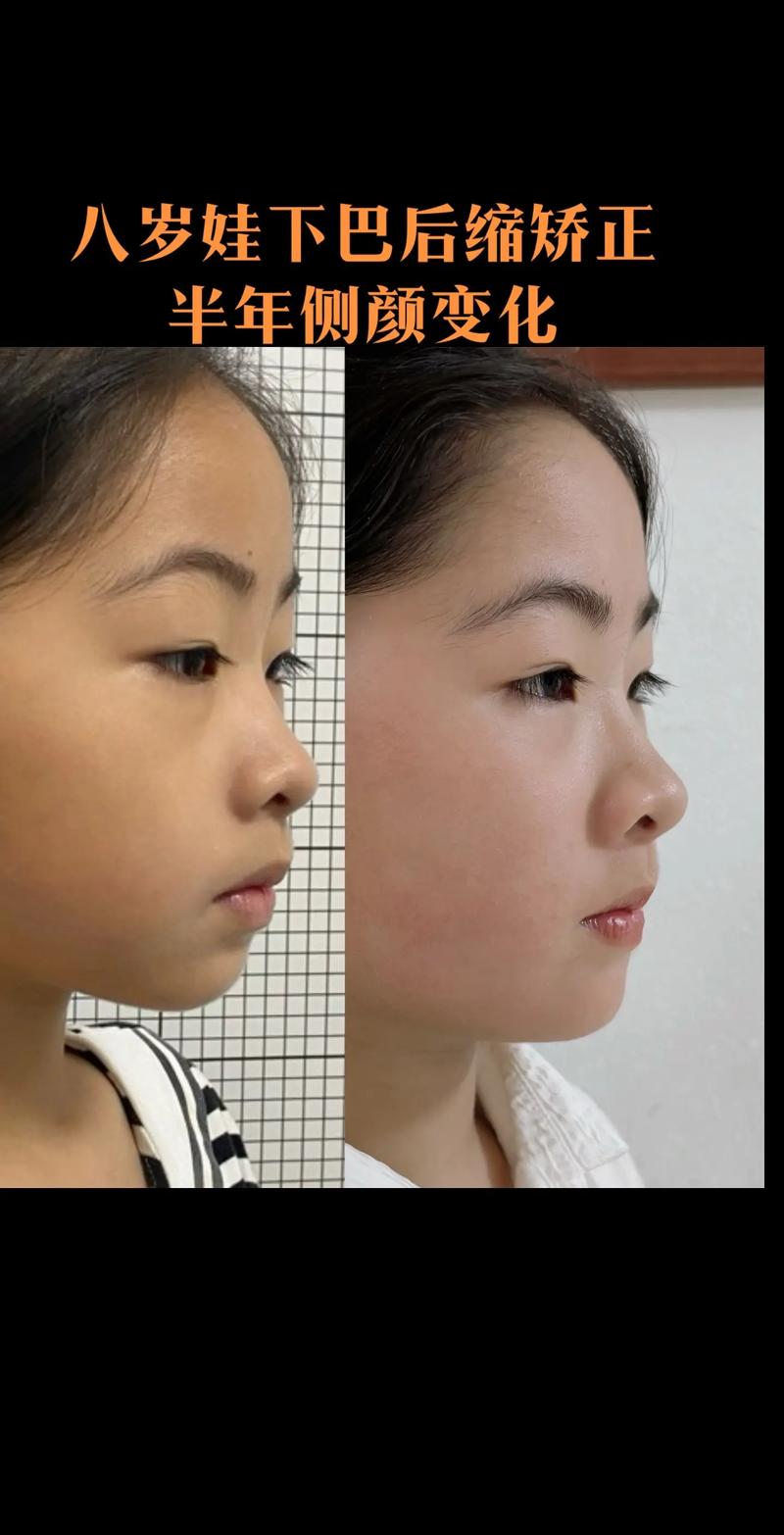 双颌前突正畸前后,脸型和咬合改善效果究竟如何?-图1 双颌前突正畸前后,脸型和咬合改善效果究竟如何?-图1