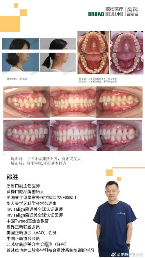 双颌前突正畸前后,脸型和咬合改善效果究竟如何?-图3 双颌前突正畸前后,脸型和咬合改善效果究竟如何?-图3