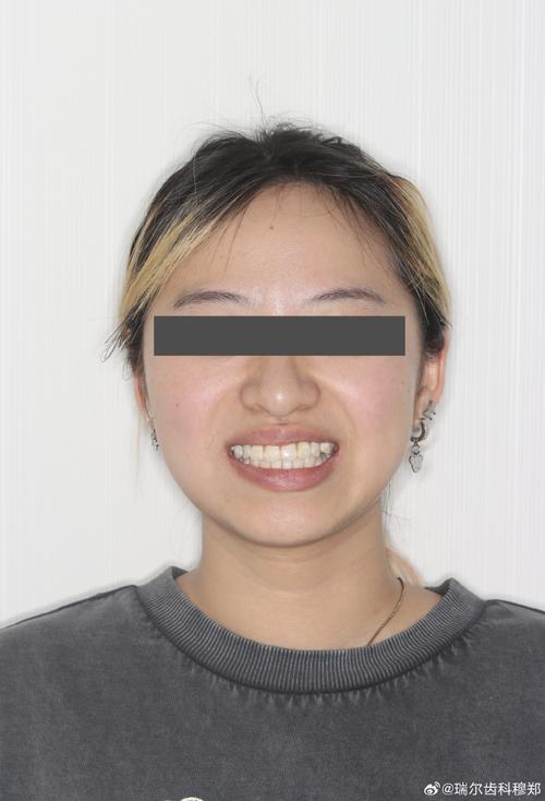轻微双颌前突正畸，矫正有必要吗？效果如何？-图1