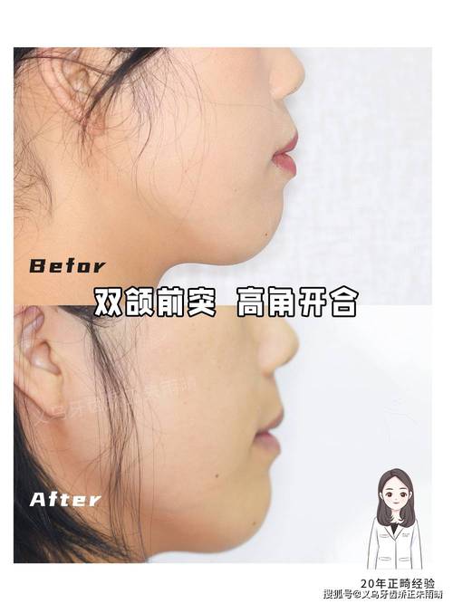 轻微双颌前突正畸，矫正有必要吗？效果如何？-图2