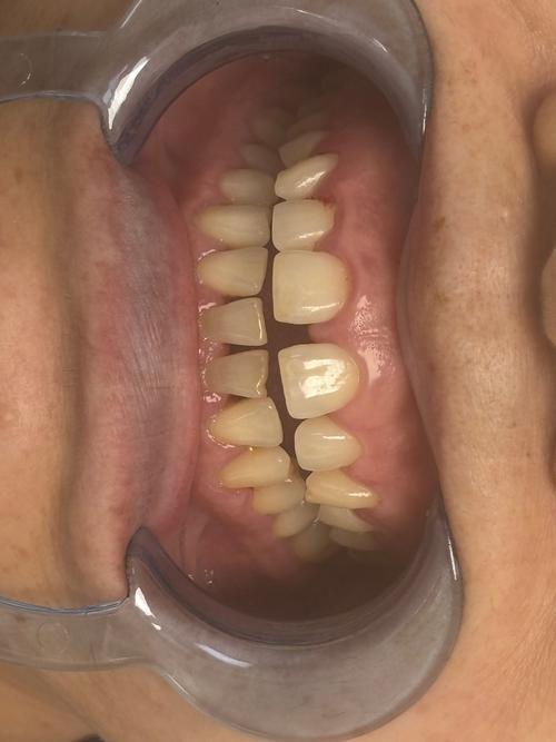 正畸牙缝变大、磨牙不止，原因和对策是什么？-图3